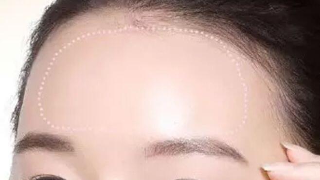 自体脂肪丰额头的效果好吗