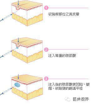 玻尿酸 玻尿酸